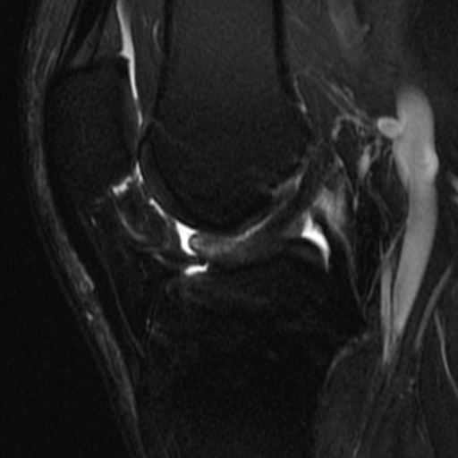 Posttraumatic cyclops lesion of the knee | Image | Radiopaedia.org