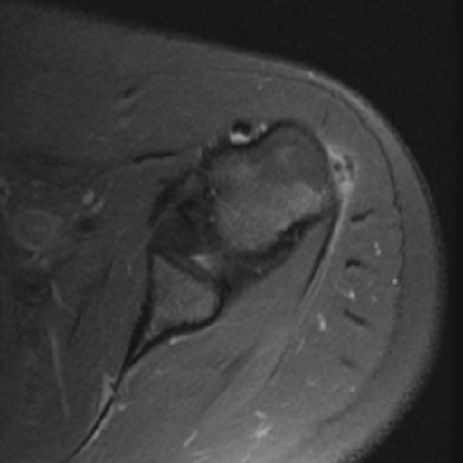 Calcific teres minor tendonitis | Image | Radiopaedia.org