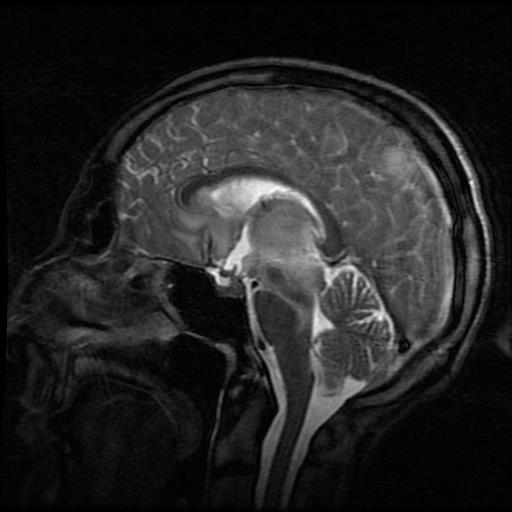 Cerebral toxoplasmosis | Image | Radiopaedia.org