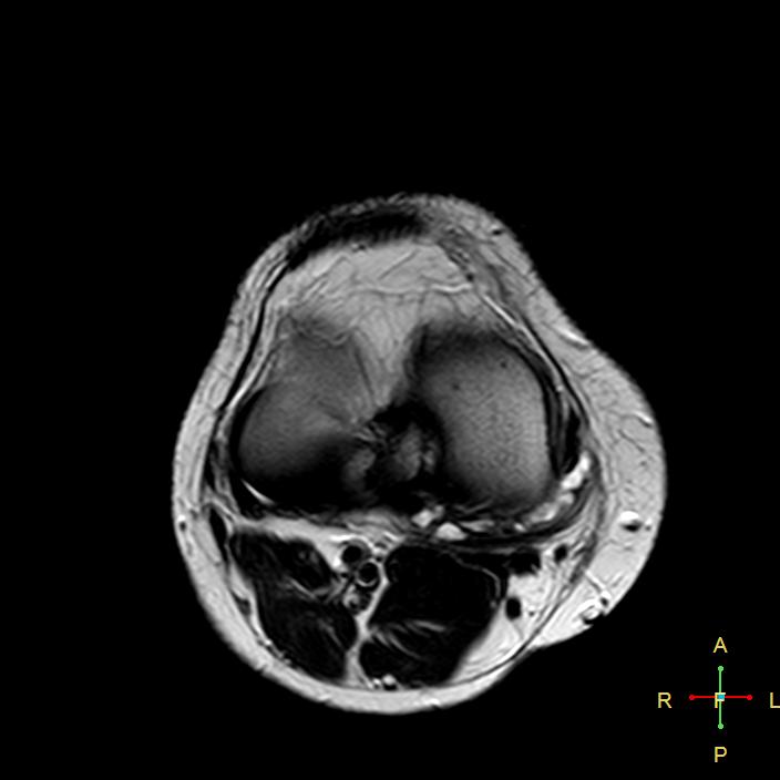 Meniscal Tear And Parameniscal Cyst Image 7311