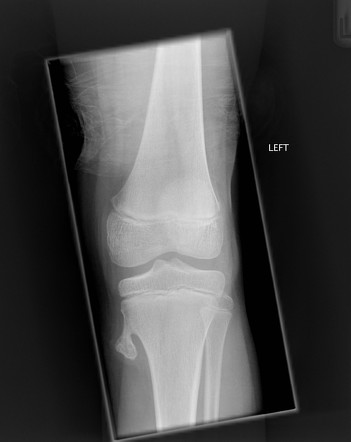 Osteochondroma | Radiology Case | Radiopaedia.org