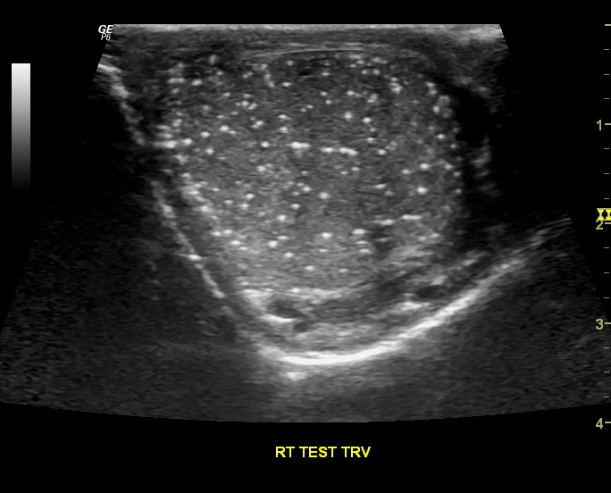 Testicular Microlithiasis Image