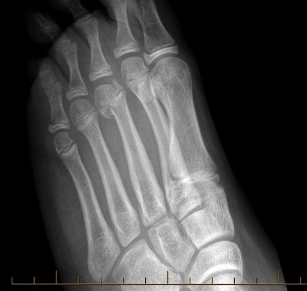 Salter-Harris type IV fracture | Radiology Reference Article ...