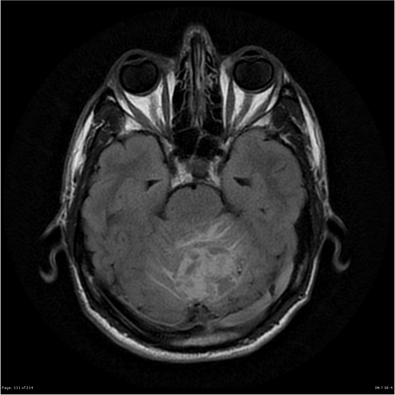 Hemangioblastoma | Image | Radiopaedia.org