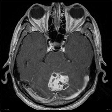 Hemangioblastoma | Image | Radiopaedia.org