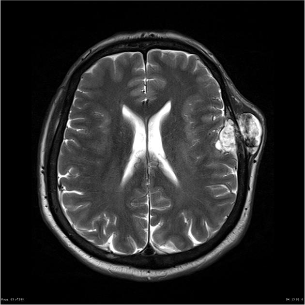 Subarachnoid hemorrhage MRI - Questions and Answers ​in MRI