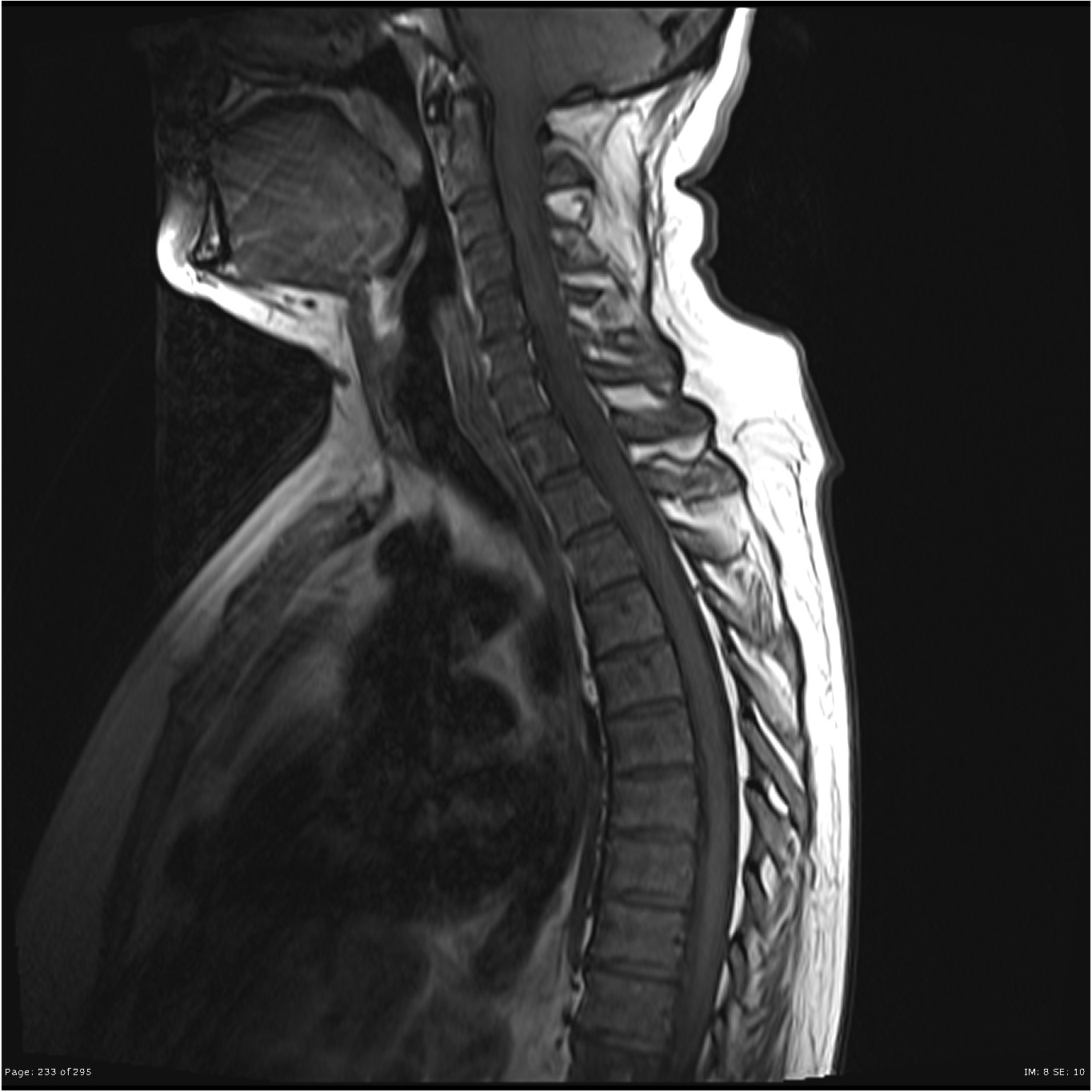 Sacral chordoma with metastases | Image | Radiopaedia.org