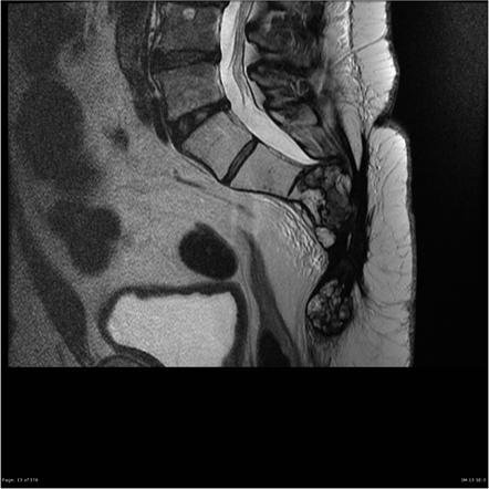 Sacral chordoma with metastases | Image | Radiopaedia.org