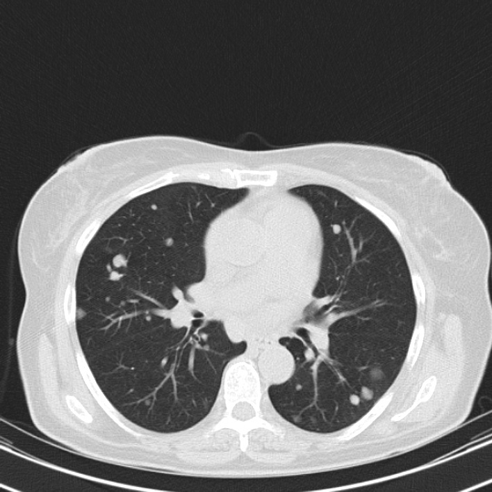 Metastatic renal cell carcinoma - bones and lungs | Image | Radiopaedia.org