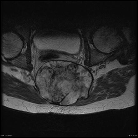 Chordoma | Radiology Reference Article | Radiopaedia.org