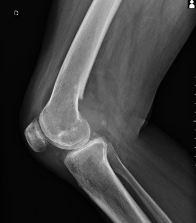 Metastatic renal cell carcinoma - bones and lungs | Radiology Case ...