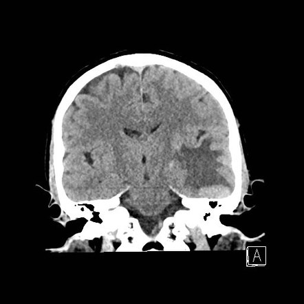 Chloroma - acute myeloid leukemia | Image | Radiopaedia.org