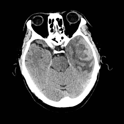 Chloroma - acute myeloid leukemia | Image | Radiopaedia.org