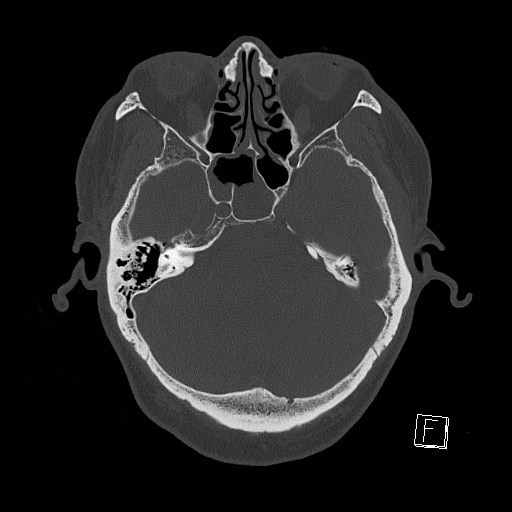 Chloroma - acute myeloid leukemia | Image | Radiopaedia.org