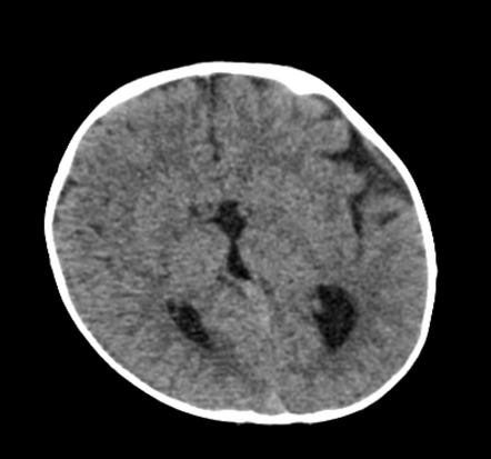 Corpus callosum dysgenesis | Radiology Case | Radiopaedia.org