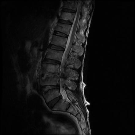 Spondylodiscitis | Radiology Case | Radiopaedia.org