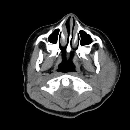 Salivary Gland Trauma Radiology Reference Article Radiopaedia Org