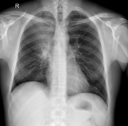 which is right and left in a chest x ray