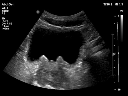 Cystitis glandularis | Radiology Reference Article | Radiopaedia.org