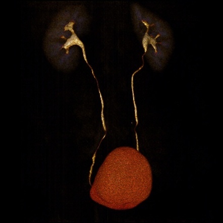 Cystitis glandularis with intestinal metaplasia | Image | Radiopaedia.org