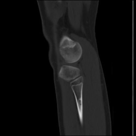 Non-ossifying fibroma - fibula | Image | Radiopaedia.org