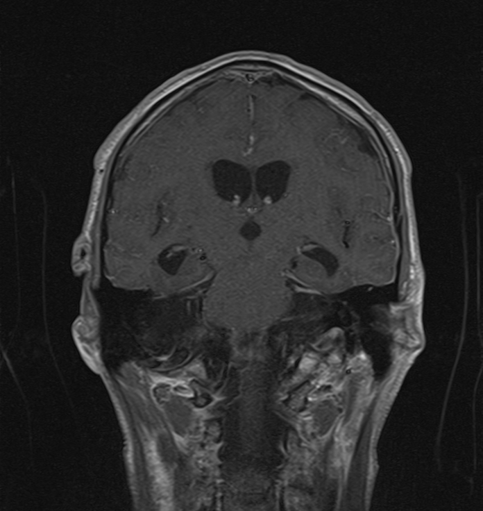 Meningitis - septation of subarachnoid spaces | Image | Radiopaedia.org