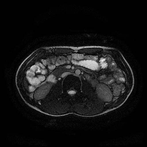 Normal Mr Enterography Image