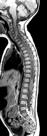 Ependymoma - spinal cord | Radiology Case | Radiopaedia.org