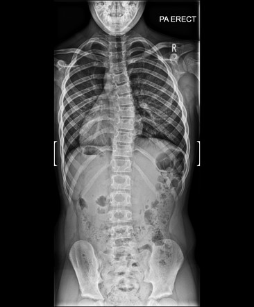 Spondylolysis and anterolisthesis with scoliosis | Radiology Case ...