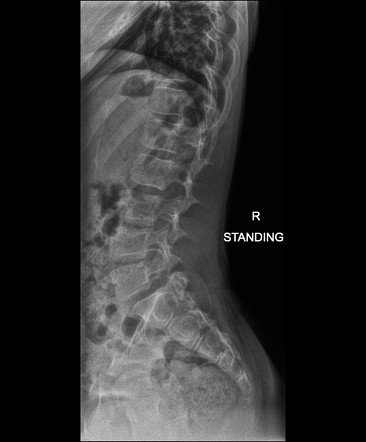 Spondylolysis and anterolisthesis with scoliosis | Image | Radiopaedia.org