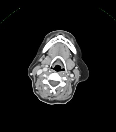 Subcutaneous lipoma - cervical region | Radiology Case | Radiopaedia.org