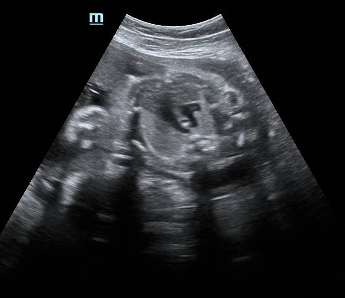 Right Sided Aortic Arch Fetal Ultrasound Image 