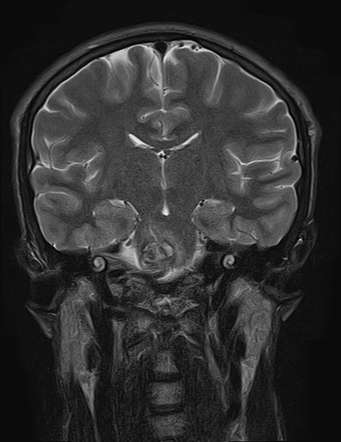 Cavernoma - pons | Image | Radiopaedia.org