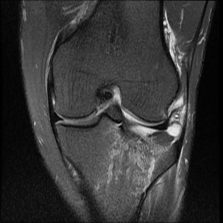 Lipohemarthrosis (MRI) | Image | Radiopaedia.org