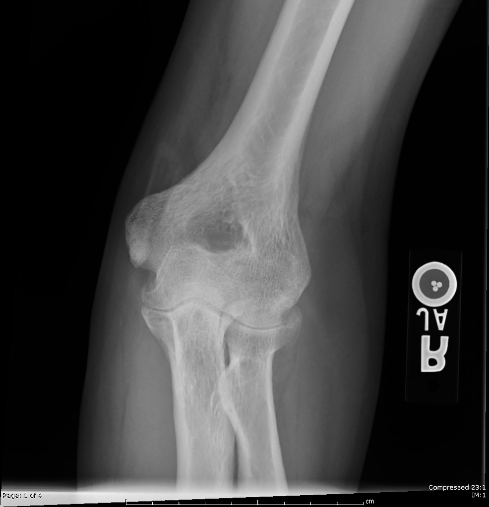 Rheumatoid Arthritis Radiology Case Radiopaedia Org