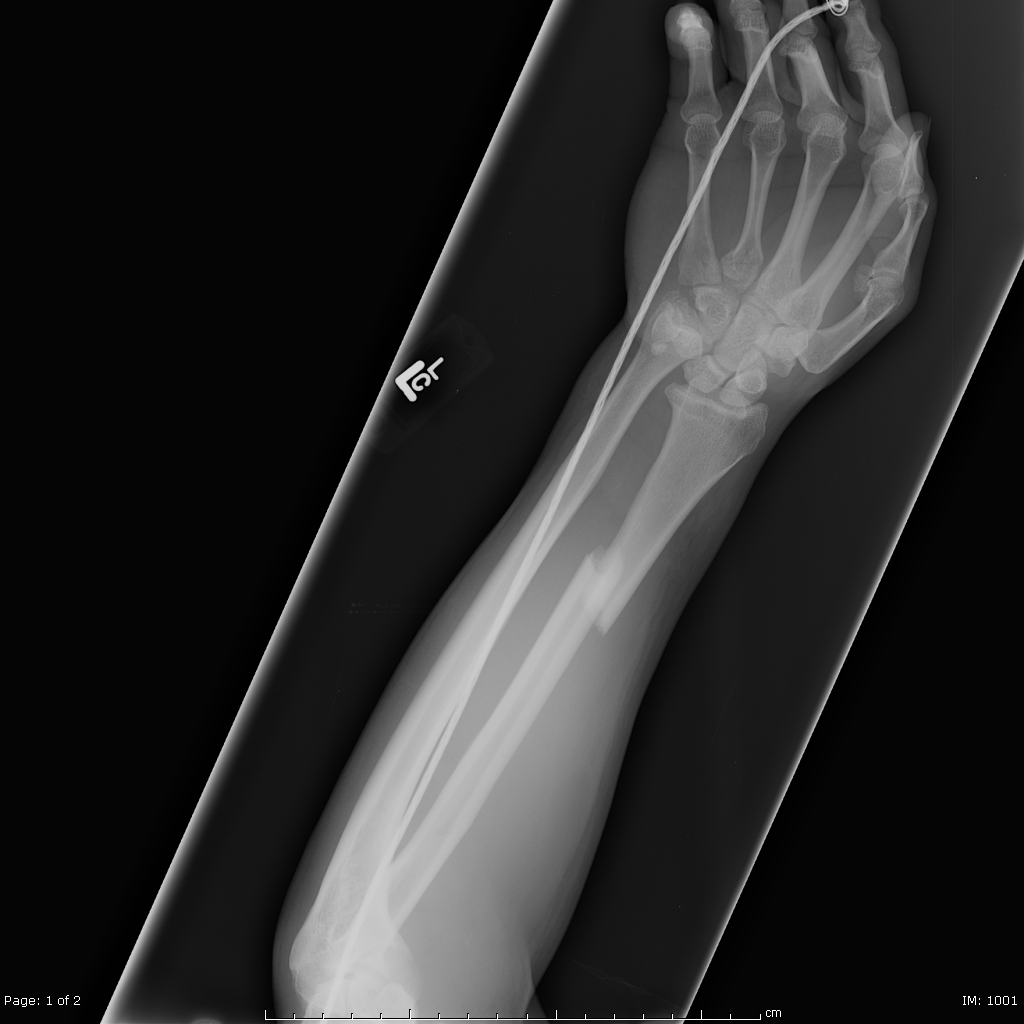 Galeazzi fracture dislocation | Image | Radiopaedia.org