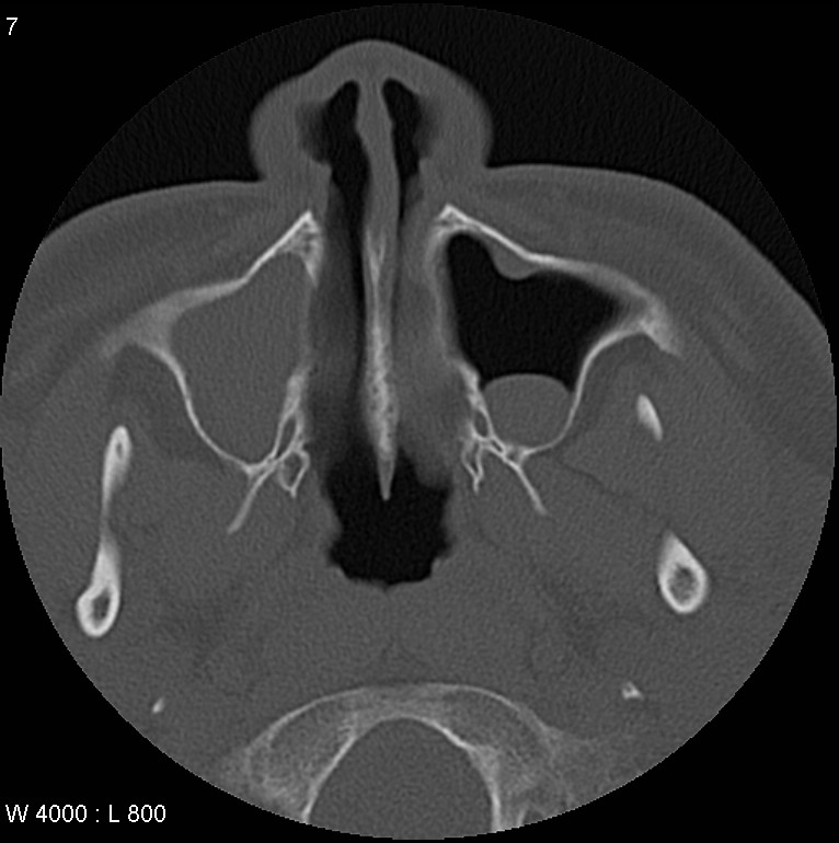 Pott puffy tumor with cerebral abscess | Image | Radiopaedia.org