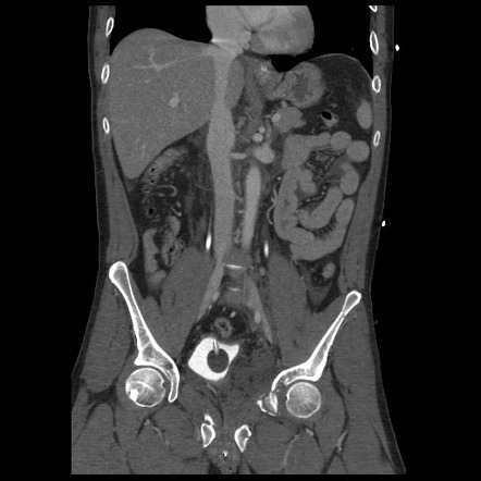 Intraperitoneal bladder rupture | Image | Radiopaedia.org