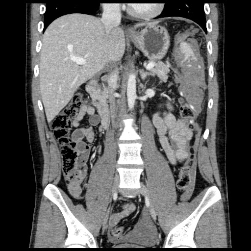 Splenic injury - AAST grade V | Image | Radiopaedia.org