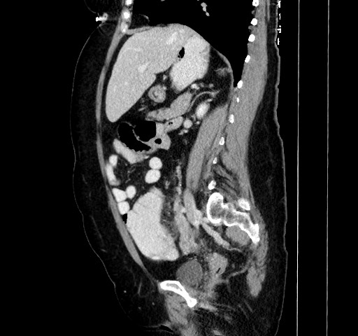 File:Acute appendicitis, heterotaxy syndrome (Radiopaedia 66884-76202 ...