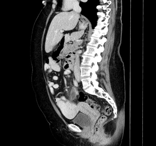 Acute appendicitis, heterotaxy syndrome | Image | Radiopaedia.org