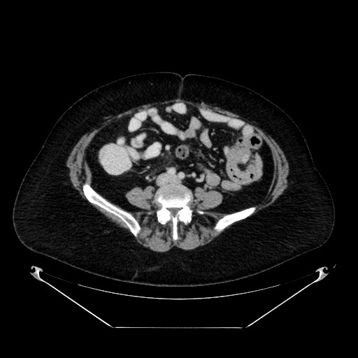 File:Acute appendicitis, heterotaxy syndrome (Radiopaedia 66884-76202 ...