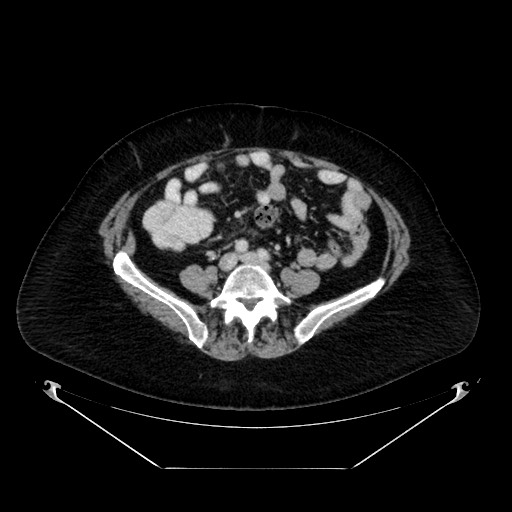 File:Acute appendicitis, heterotaxy syndrome (Radiopaedia 66884-76202 ...