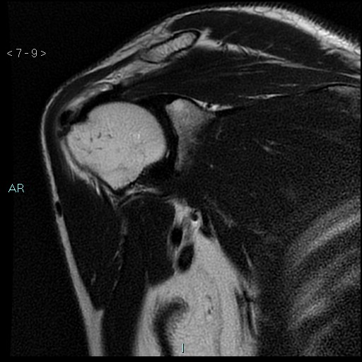 Intraosseous migration of supraspinatus tendinous calcification | Image ...