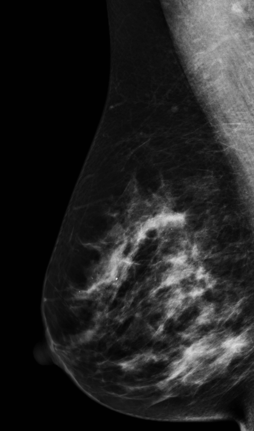 Extensive Ductal Carcinoma In Situ | Image | Radiopaedia.org