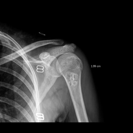 Non-ossifying fibroma | Radiology Reference Article | Radiopaedia.org