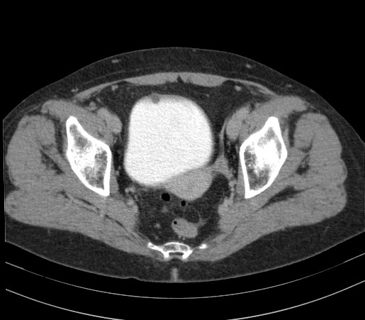 Intravesical urachal cyst | Image | Radiopaedia.org