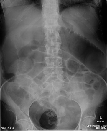 Large bowel obstruction on abdominal radiograph from colorectal cancer ...