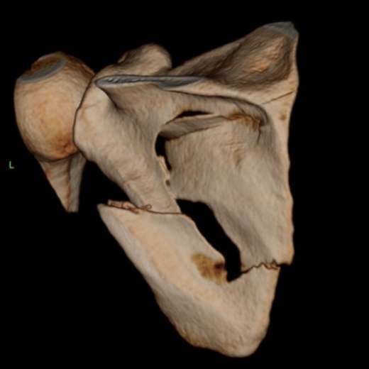 Классификация переломов лопатки рисунок