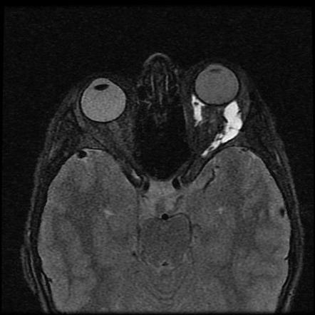 Orbital lymphatic malformation | Image | Radiopaedia.org